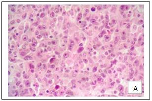 Enteropathy-Type T-Cell Lymphoma Refractor to Chemotherapy: A Case Report