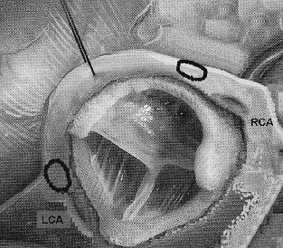 Immediate Thrombosis of Left Main Stem After Aortic Valve Replacement