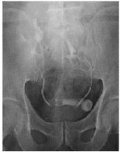 Bilateral Pelvichorse Shoe Kidney With Renal, Bladder Calculus And Obstructive Symptoms