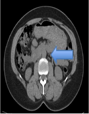 Rapidly Expanding Infected Aortic Aneurysm Caused by Haemophilus Influenzae In a 51-year-old HIV- Positive Patient