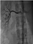 Acute Pulmonary Edema after Endovascular Treatment for Renal Artery Stenosis - Clinical Evolution after Angioplasty and Stenting in Moderate Stenosis:A Case Report