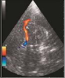 Ultrasonographic Characteristics of Carotid and Middle Cerebral Arteries in Patients with Ischemic Stroke