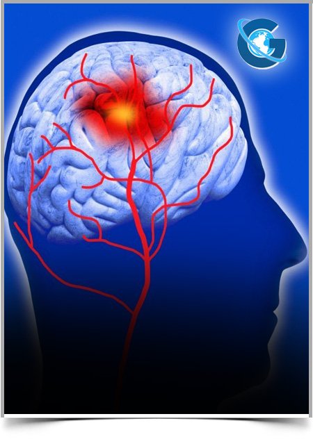 Why the Nine Hole Peg Test should not Disappear from Clinical Stroke Routine