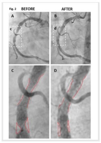 coronary artery