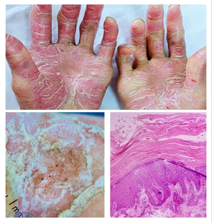 Clinico-Histopathological and Dermoscopic Correlation in Hyperkeratotic ...